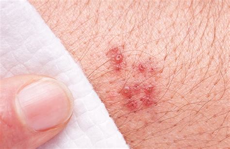 shingles armpit|Shingles: Signs and symptoms .